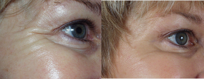 Botox before and after photo