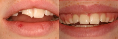 Dental Crown before and after photo