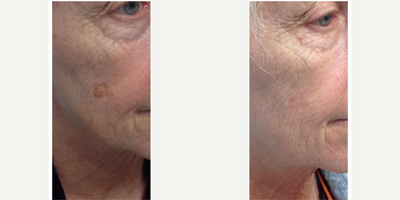 Excel V before and after photo