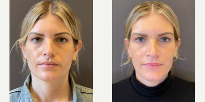 Eyelid Surgery before and after photo