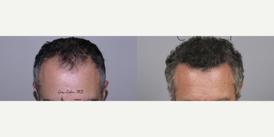 Hair Transplant before and after photo