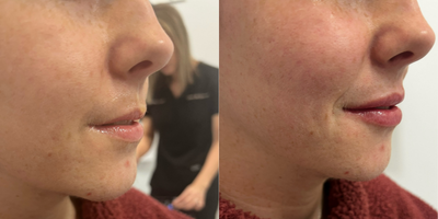 RHA Collection Fillers before and after photo
