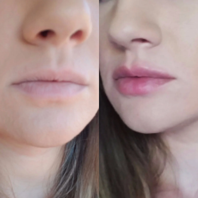 Lip Fillers before and after photo