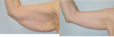 Arm Lift before and after photo