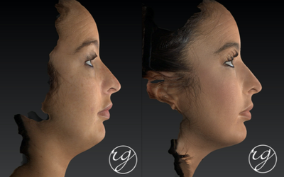 Dermal Fillers before and after photo