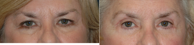 Eyelid Surgery before and after photo