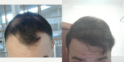 FUE Hair Transplant before and after photo