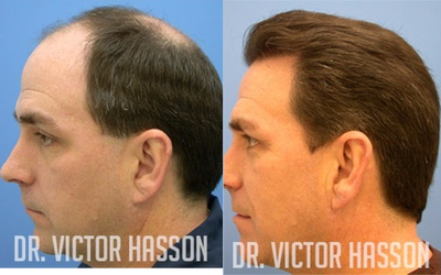 Hair Transplant before and after photo