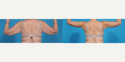 Arm Lift before and after photo