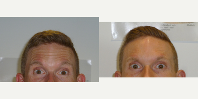 Botox before and after photo