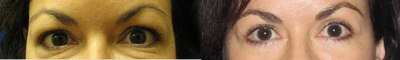 Eyelid Surgery before and after photo