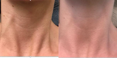 Fractional Laser before and after photo