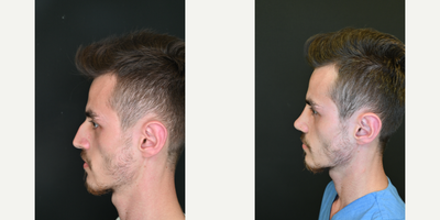 Rhinoplasty before and after photo