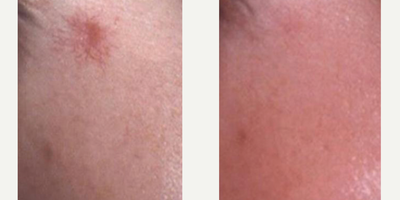 YAG Laser before and after photo