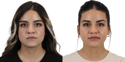 Dermal Fillers before and after photo