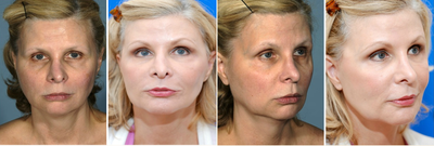 Facelift before and after photo