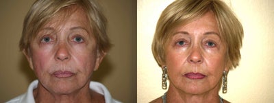 Sculptra before and after photo