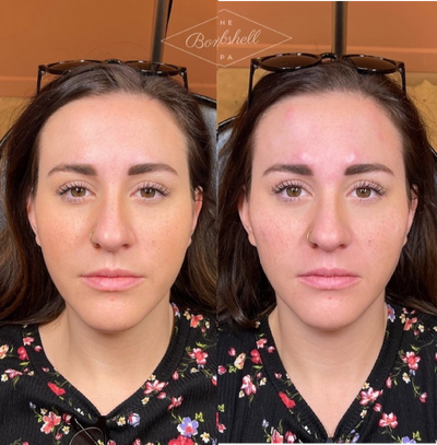 Botox before and after photo