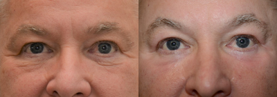 Chemical Peel before and after photo