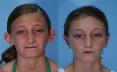 Ear Surgery before and after photo