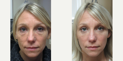 Eyelid Surgery before and after photo