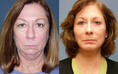 Facelift before and after photo
