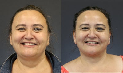 Neck Lift before and after photo