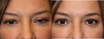 Ptosis Surgery before and after photo