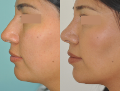 Rhinoplasty before and after photo