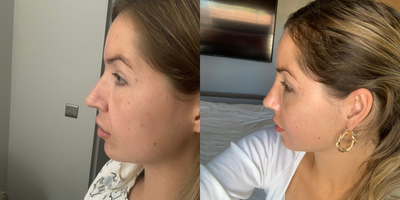 Rhinoplasty before and after photo
