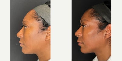 Cheek Fillers before and after photo