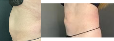 Emsculpt before and after photo