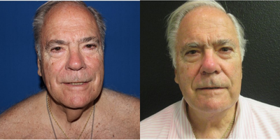 Neck Lift before and after photo
