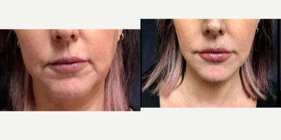 Vollure before and after photo