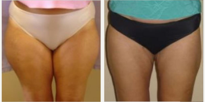 Liposuction before and after photo