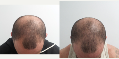 PRP for Hair Loss before and after photo