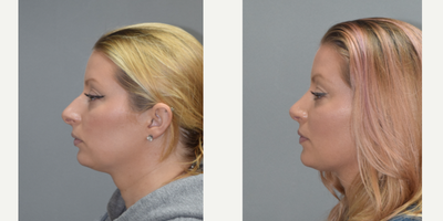 Rhinoplasty before and after photo
