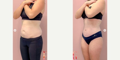 Tummy Tuck before and after photo