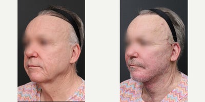 Eyelid Surgery before and after photo