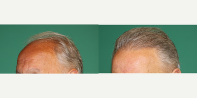 Hair Transplant before and after photo