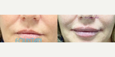 Lip Fillers before and after photo
