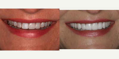 Smile Makeover before and after photo