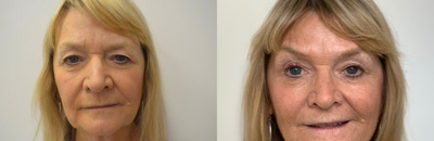 Botox before and after photo