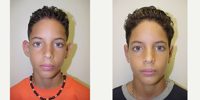 Ear Surgery before and after photo