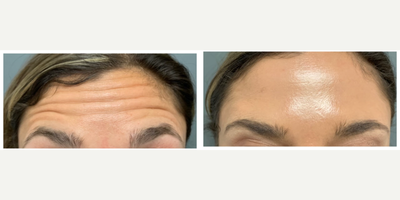 Botox before and after photo