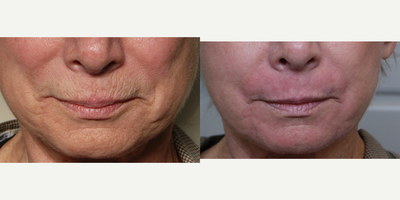 CO2 Laser before and after photo