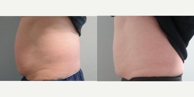 CoolSculpting before and after photo