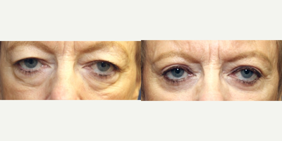 Eyelid Surgery before and after photo