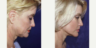Neck Lift before and after photo