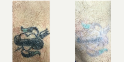Tattoo Removal before and after photo